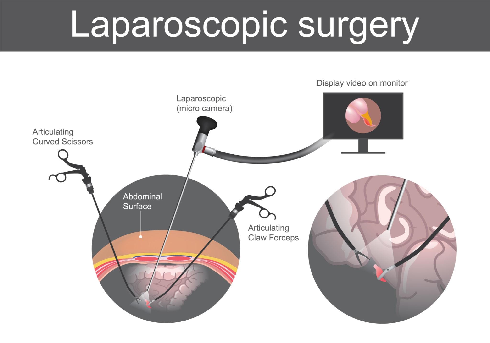 Educational illustration of laparoscopic surgery